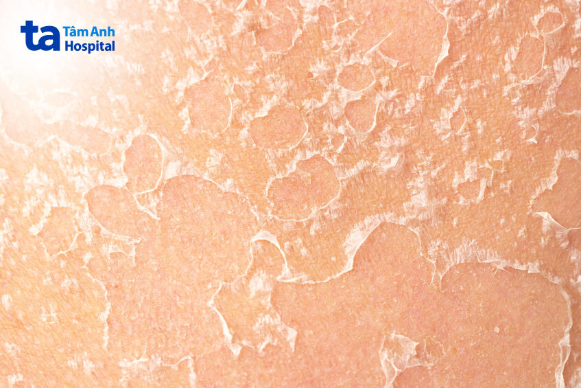 da đang bong tróc và khô không nên peel da