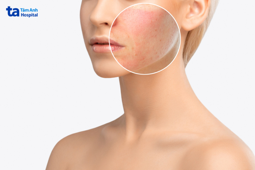 da đỏ đau rát kéo dài sau peel