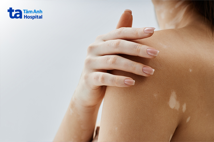 da mất sắc tố có nguy hiểm không