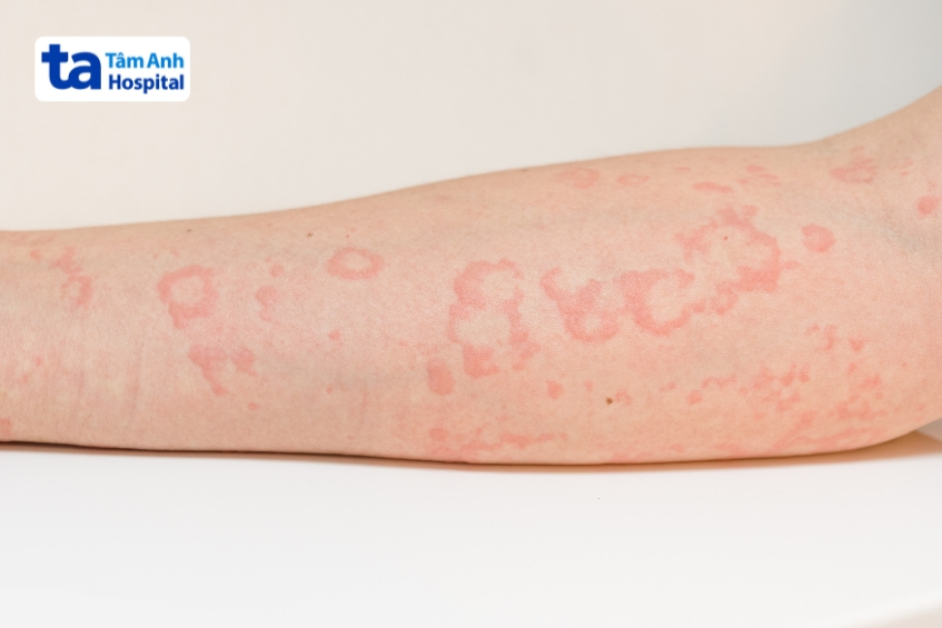 Vùng da cánh tay bị nổi mẩn đỏ do phản ứng dị ứng histamin