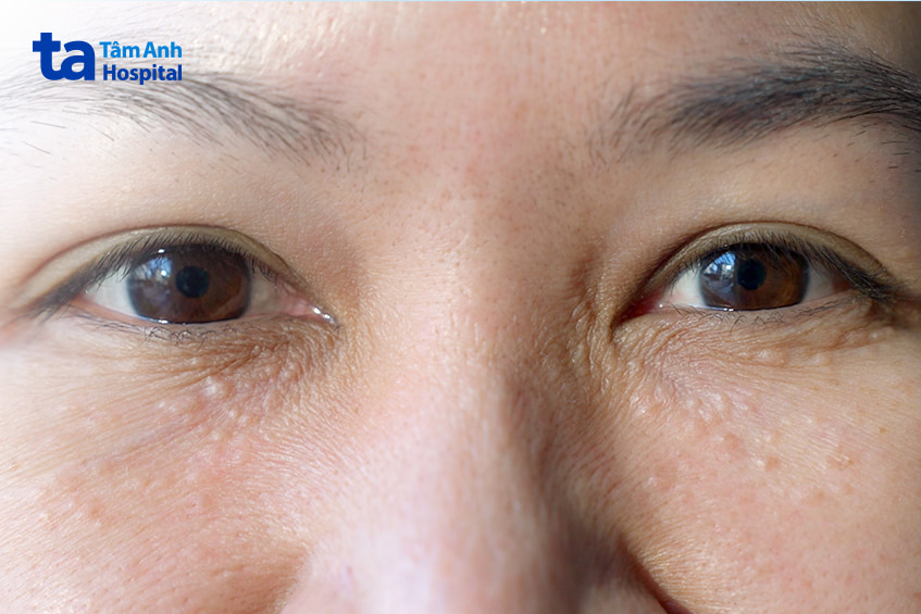 Hình ảnh vùng da cải thiện sau điều trị u tuyến mồ hôi, giảm rõ rệt nốt trắng