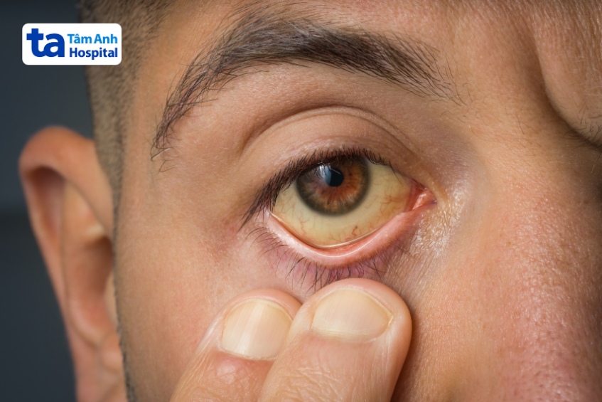 da vàng mắt vàng bệnh gan mật