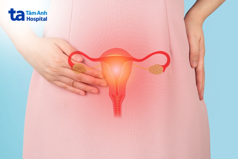 đau buồng trứng phải