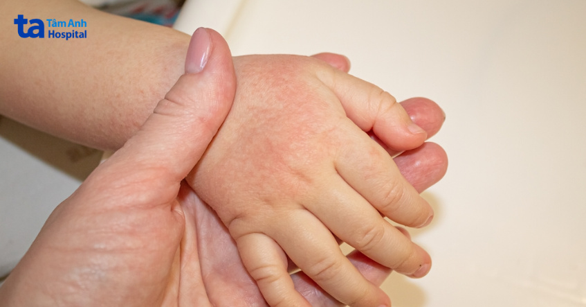 dấu hiệu bé bị viêm da tiếp xúc