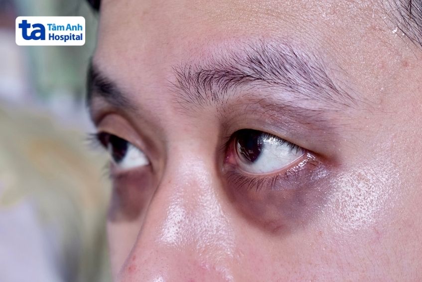 dấu hiệu kính râm dễ nhầm lẫn với vết bầm tím