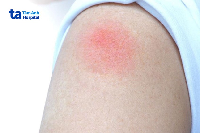 vùng da tiêm vắc xin bị đỏ sưng