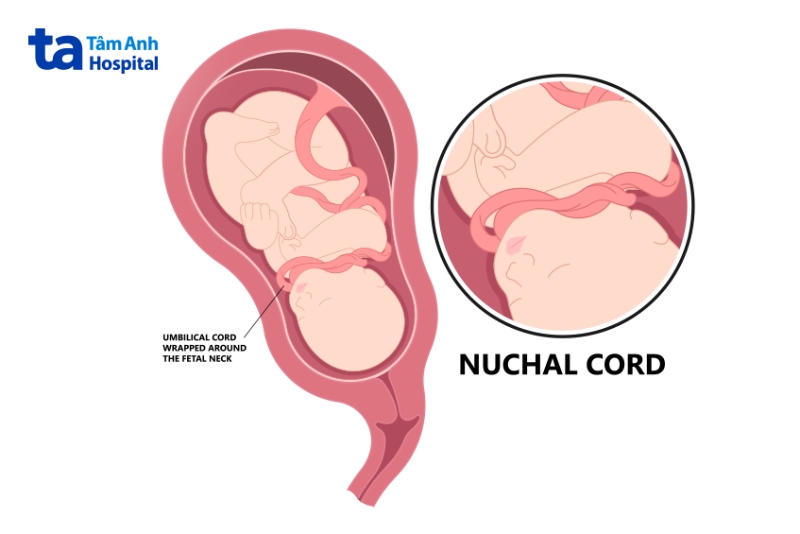 dây rốn quấn cổ