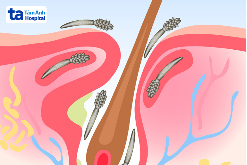 demodex ký sinh bên trong lỗ chân lông