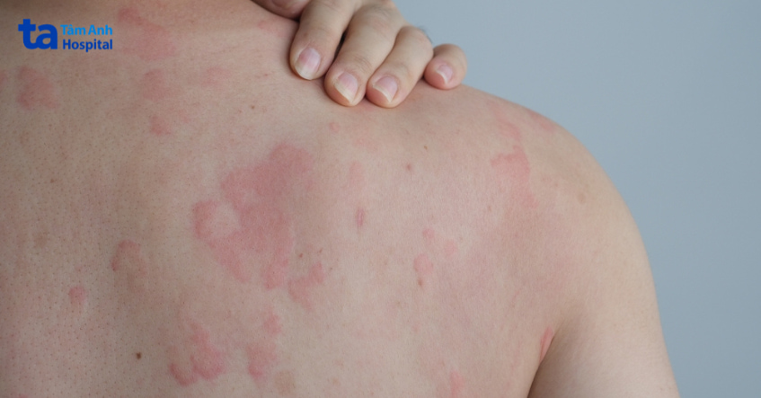 Tổn thương da mề đay, dị ứng da do histamin gây ra, thường được điều trị bằng thuốc kháng histamin