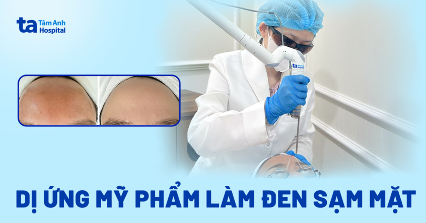 Dị ứng mỹ phẩm làm đen sạm hết mặt
