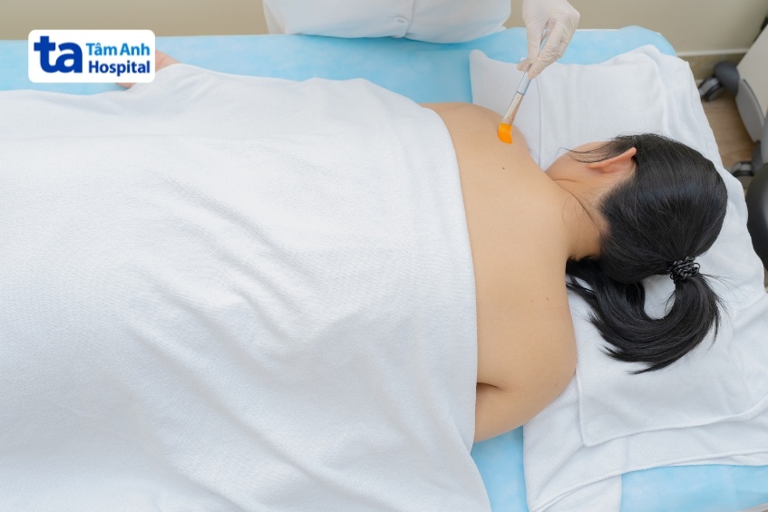 điều trị da sạm đen ở lưng bằng liệu pháp chuyên sâu