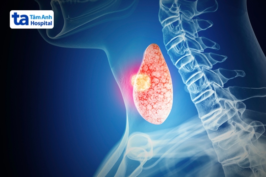 điều trị ung thư vòm họng bằng xạ trị có thể gây suy giáp