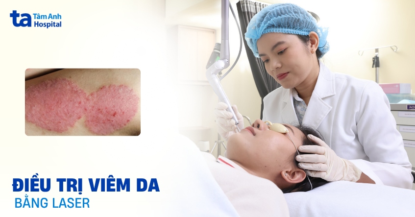 Điều trị viêm da bằng laser có hiệu quả và an toàn?