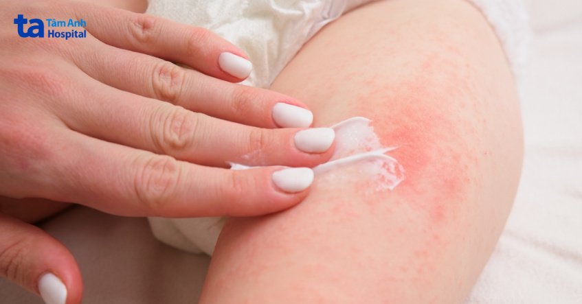 điều trị viêm da tiếp xúc cho trẻ