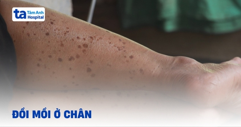 Đồi mồi ở chân và những thông tin cần lưu tâm