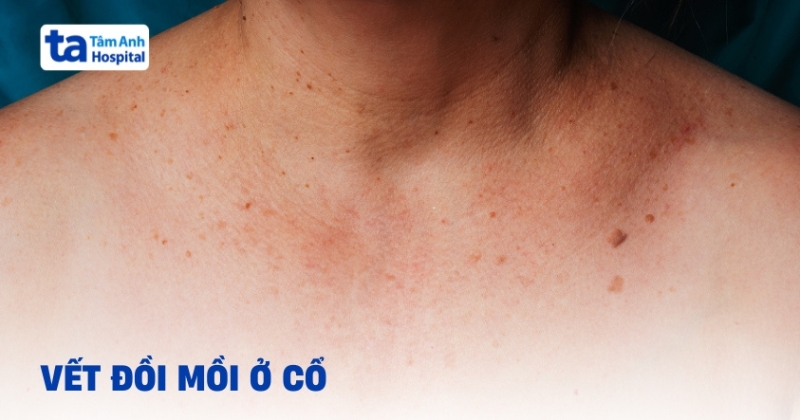 Xuất hiện đồi mồi ở cổ cần xử trí như thế nào?