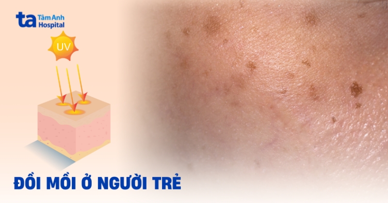 Vì sao đồi mồi ở người trẻ tuổi lại xuất hiện sớm?