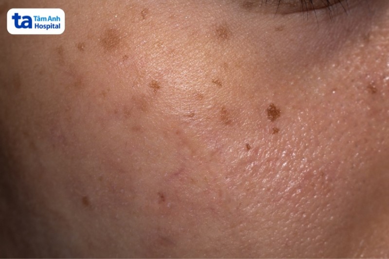 đồi mồi trên da măt người trẻ