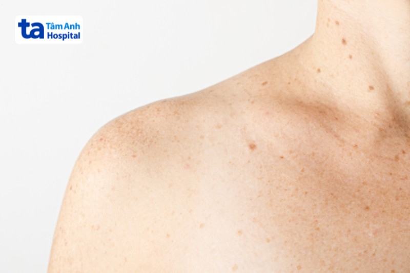 đồi mồi trên vai trong thai kỳ