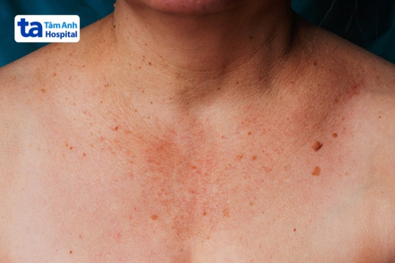 đồi mồi trên vùng cổ