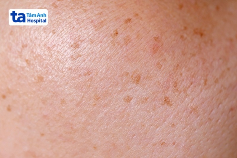 đốm nâu nhạt trên da là đồi mồi