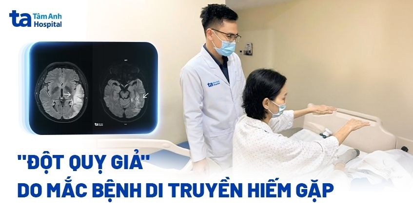 ‘Đột quỵ giả’ do mắc bệnh di truyền ít gặp