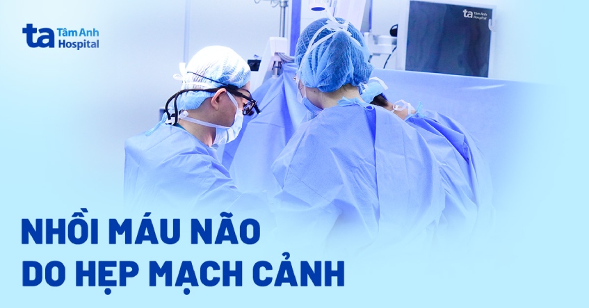 Đột quỵ vì hẹp mạch cảnh mà không biết