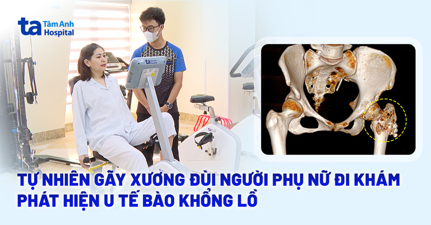 Tự nhiên gãy xương đùi, người phụ nữ đi khám phát hiện u tế bào khổng lồ
