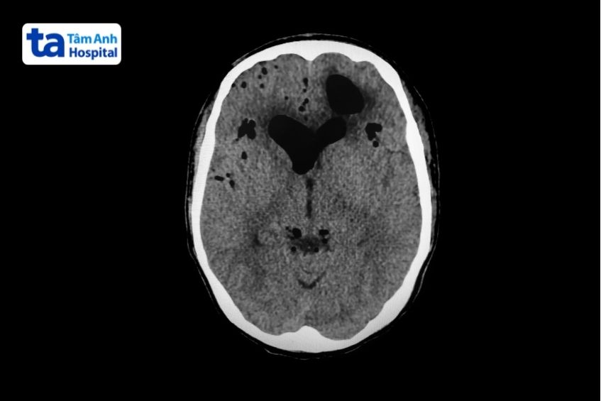 ghi nhận tràn khí trong não