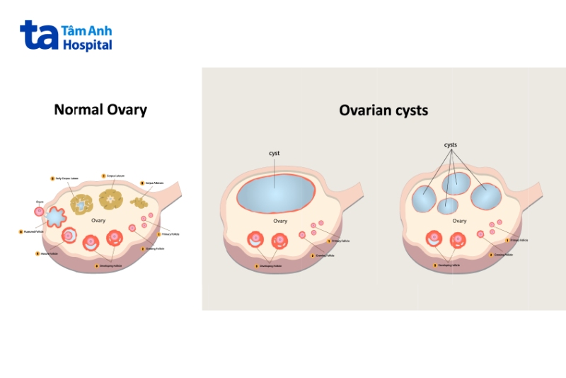 giải phẫu u bì buồng trứng