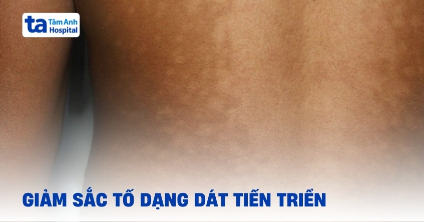 Giảm sắc tố dạng dát tiến triển (PMH): Tìm hiểu chi tiết