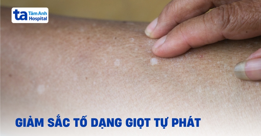 Tìm hiểu bệnh giảm sắc tố dạng giọt tự phát (IGH)