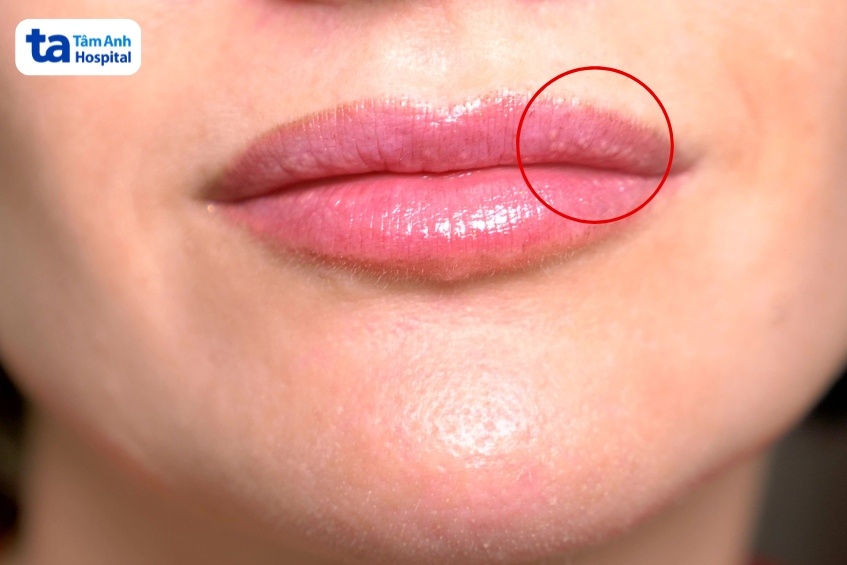 hạt Fordyce hiện rõ sau tiêm filler môi