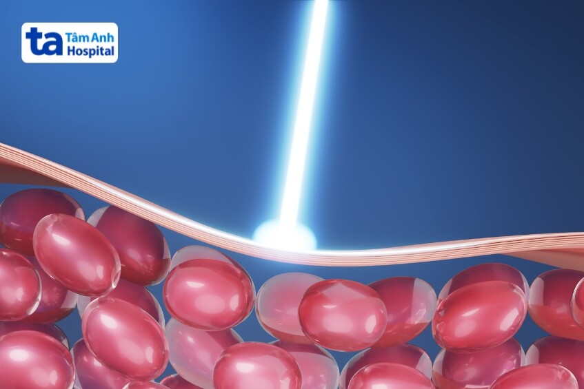 hiểu thêm về laser yag