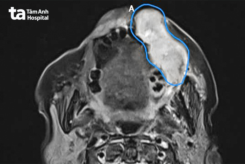 hình ảnh ct ghi nhận khối u ác tính (vùng màu xanh) từ niêm mạc miệng xâm lấn ra má, môi người bệnh