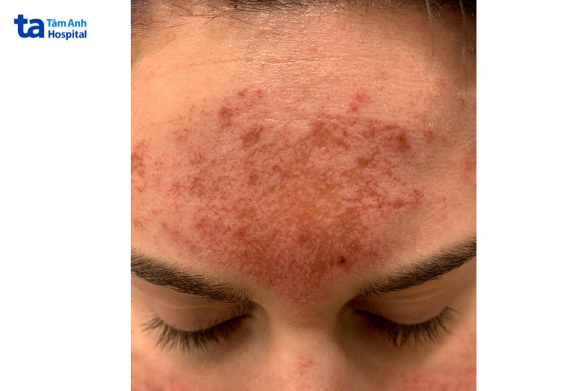 hình ảnh da bị bỏng sau peel