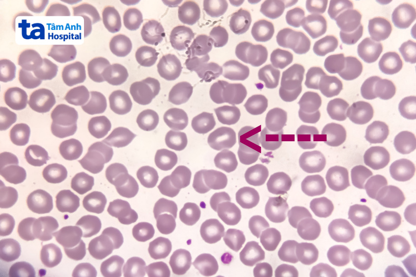 hình ảnh hồng cầu hình miệng (mũi tên trong hình)