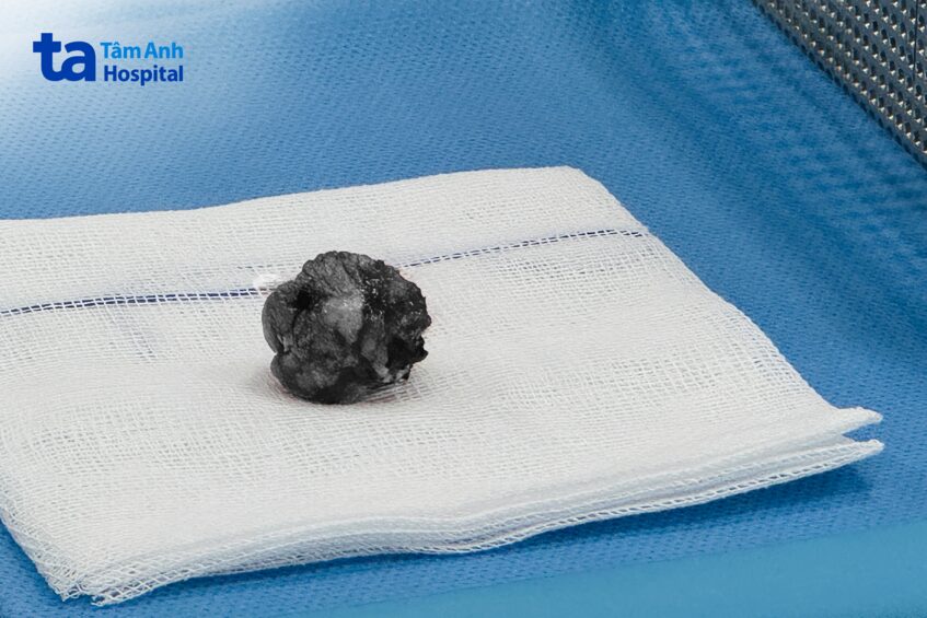 hình ảnh khối u của bệnh nhân