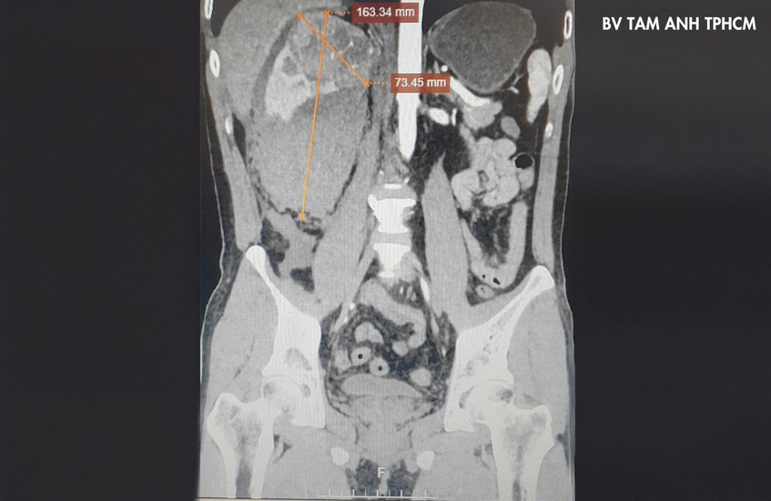 hình ảnh khối u vỡ