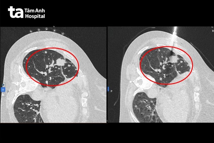 hình ảnh khối u