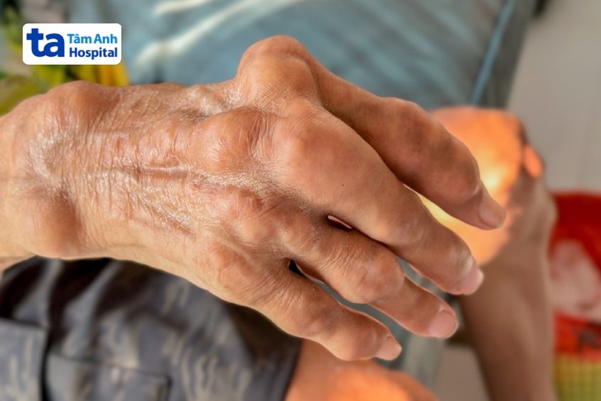 Hình ảnh khớp tay bị biến dạng