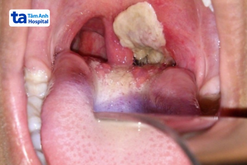 ảnh giả mạc bạch hầu nặng