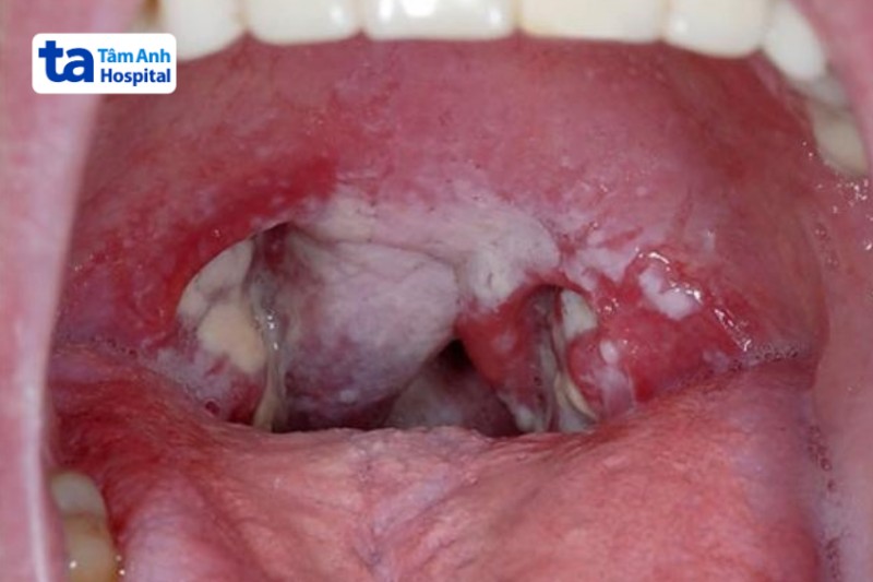 hình ảnh lớp giả mạc bạch hầu