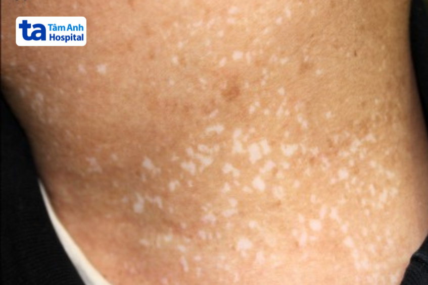 hình ảnh mất sắc tố sau laser