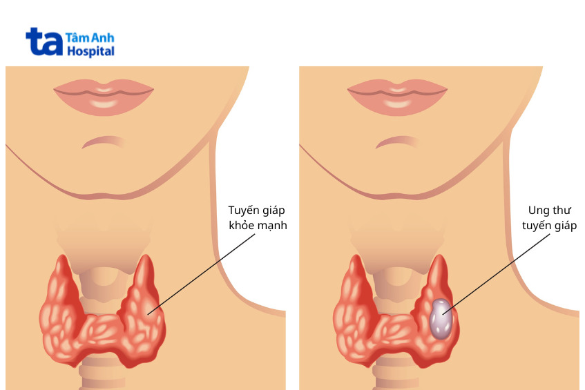 hình ảnh minh họa khối ung thư ở tuyến giáp