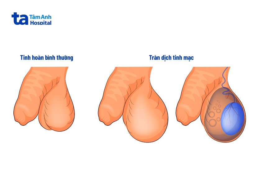 Hình ảnh minh họa tràn dịch màng tinh hoàn