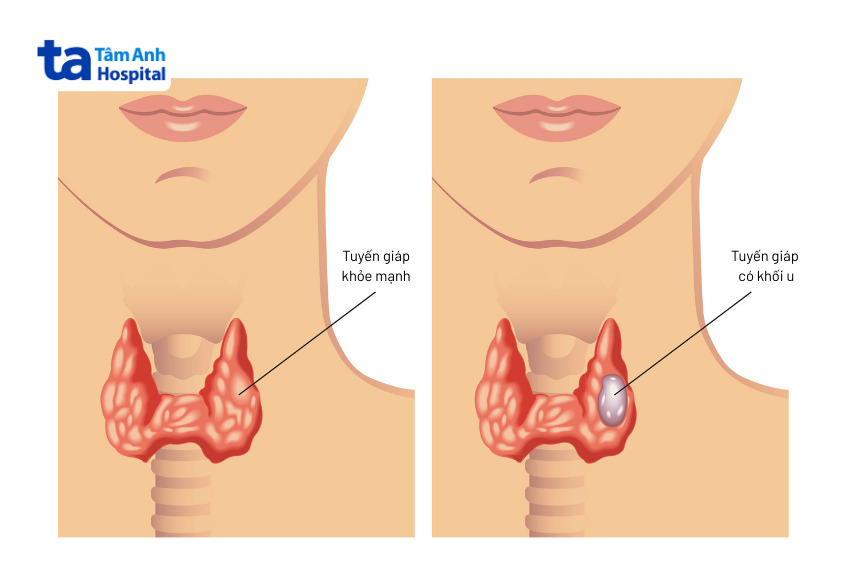 hình ảnh minh họa tuyến giáp bình thường (bên trái) và ung thư tuyến giáp (bên phải)