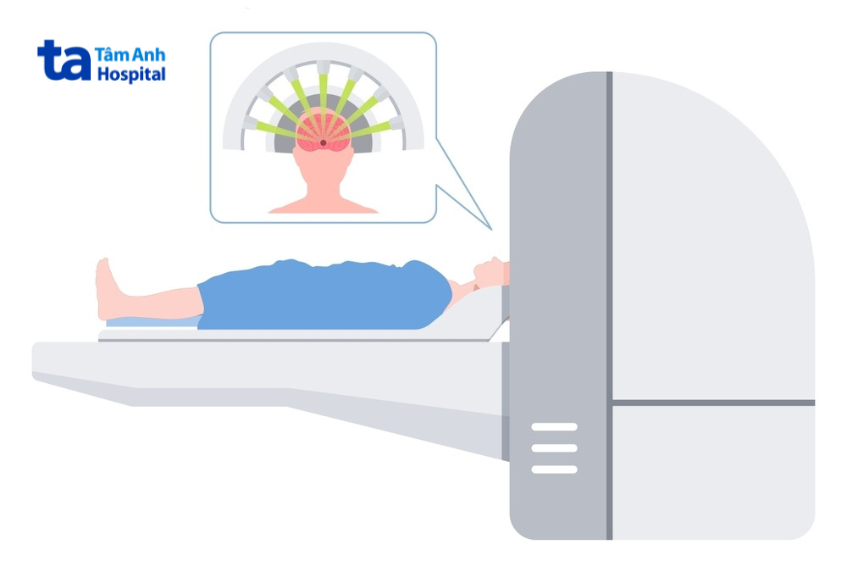 hình ảnh mô phỏng xạ phẫu não, các chùm tia bức xạ năng lượng cao hội tụ tại vị trí khối u