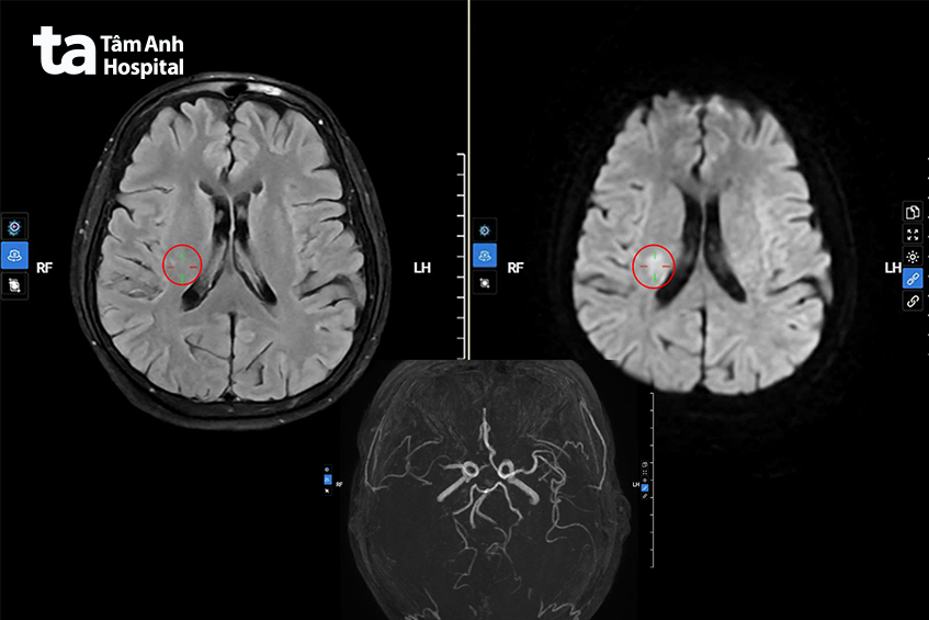 hình ảnh mri xác định vị trí nhồi máu não