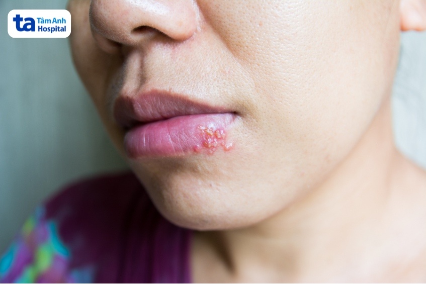 hình ảnh mụn nước do virus